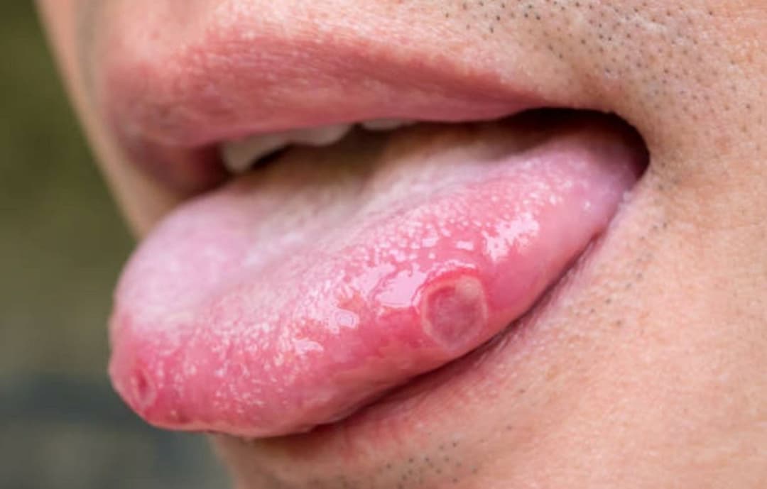 oral heat rash 