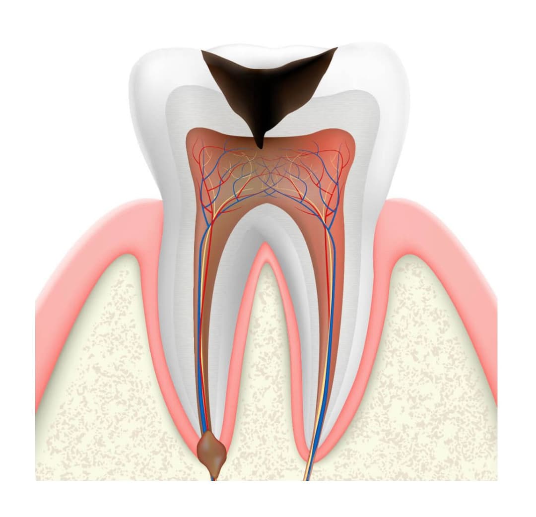 prevent cavity