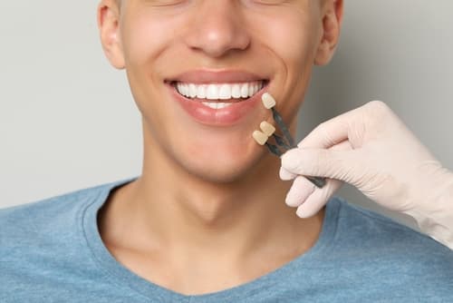 Dentist holding a veneer shade guide to match the color of a male patient’s teeth for cosmetic dental treatment.