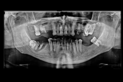 Full-mouth dental X-ray showing advanced bone loss and damaged tooth roots in a periodontal disease patient