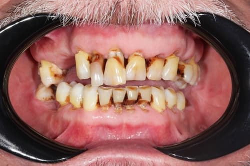 Hong Kong elderly patient with severe periodontal disease showing gum recession and loose discoloured teeth