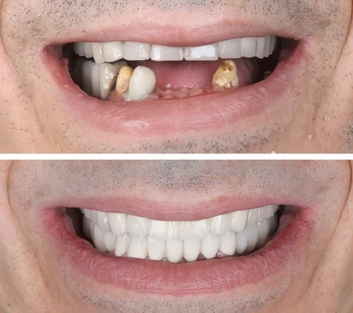 Before-and-after dental implant comparison of a male patient with severe tooth loss and full arch restoration