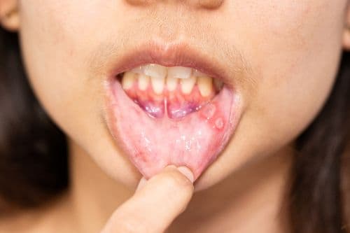 Oral Ulcers