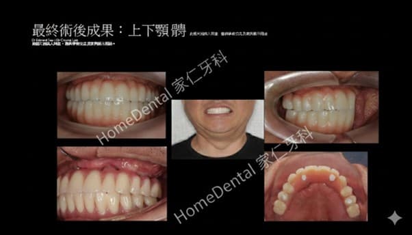 Panoramic X-ray evaluation before All-on-4 full arch implant treatment in Hong Kong