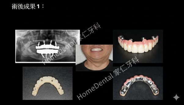 Final metal-ceramic fixed bridge restoration supported by All-on-4 implants