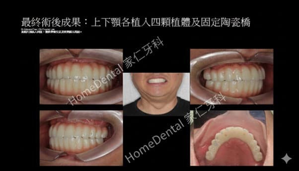 Before and after smile transformation with All-on-4 full mouth dental implants