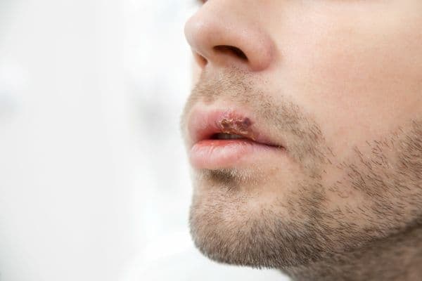Angular cheilitis 