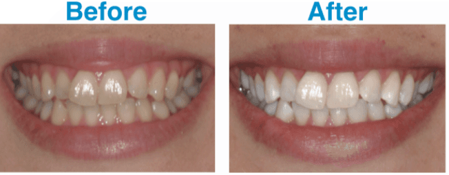 Guide to Different Methods of Teeth Whitening in Hong Kong