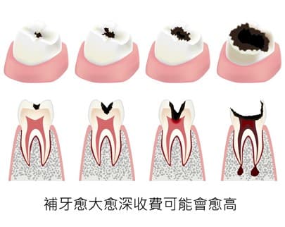 Four Factors That Affect Dental Filling Costs in Hong Kong