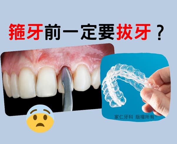 在香港做牙齒矯正(箍牙)前一定要拔牙嗎?