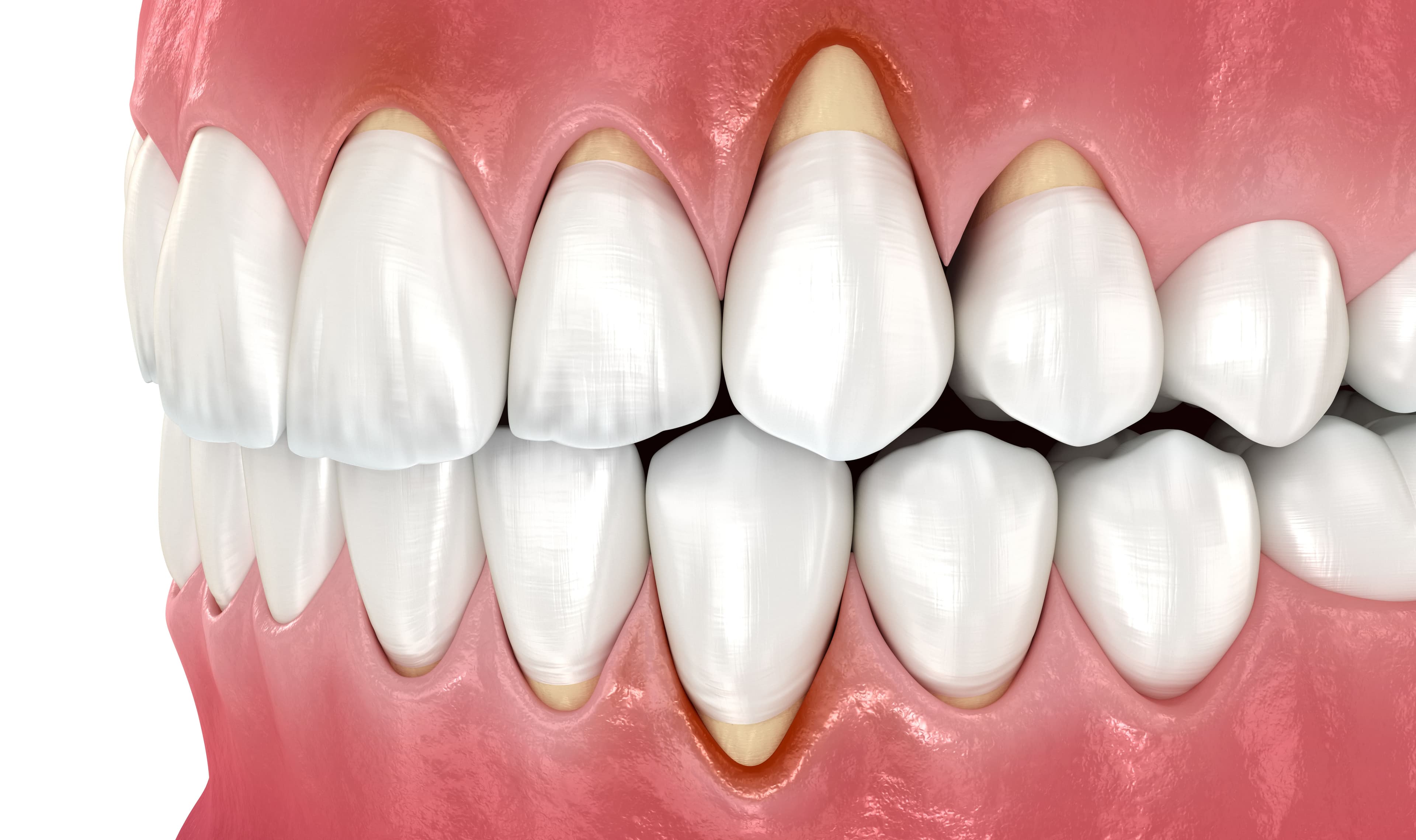 Tooth Root Pain: Pulpitis? Symptoms and Treatment of Root Inflammation Explained