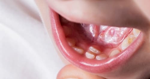 【Complete Guide to Hyperdontia】Singer Hana Kuk’s “Zombie Teeth” Experience: Causes, Symptoms, Diagnosis & Treatment of Extra Teeth
