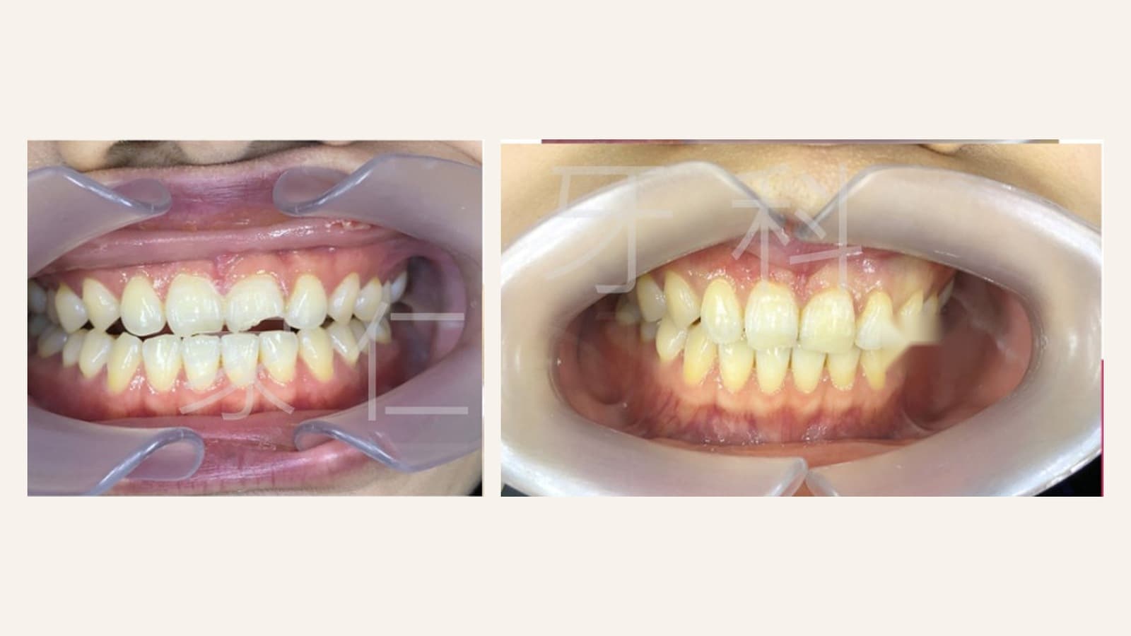 Chipped a Tooth? Treatment, Fillings and Repair Costs for Front Teeth and Molars