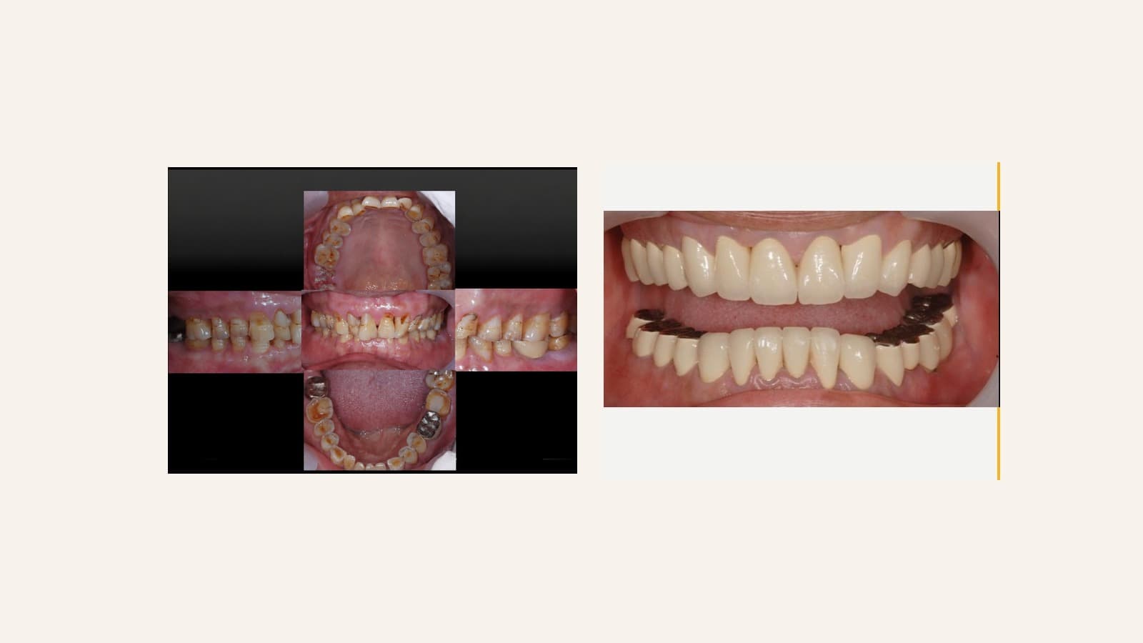 Full Mouth Rehabilitation (Occlusal Reconstruction)